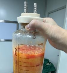 兰考水动力吸脂手术要做多久？